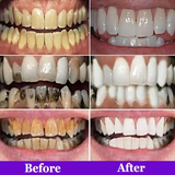 Teeth Whitening Strips