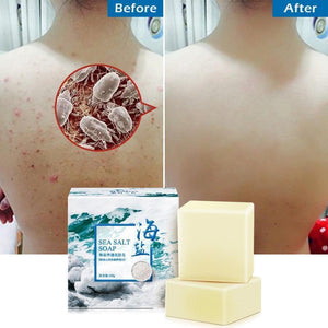 ACNE CLEANSING SOAP